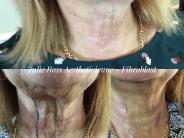 Neck healed, before & directly after